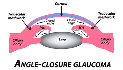 Angle closure glaucoma diagram