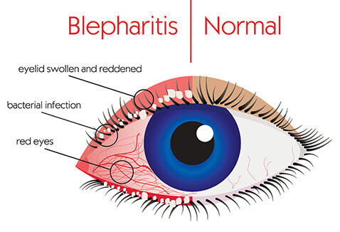 Blepharitis Diagram
