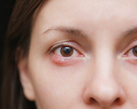 Young woman with blepharitis