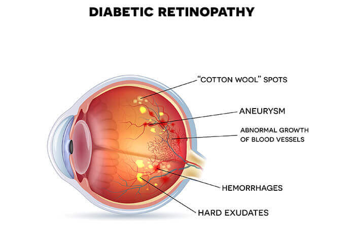 Diabetic Retinopaty Diagram