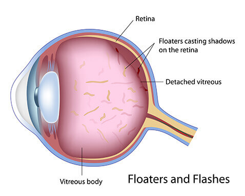 Flashes and Floaters diagram