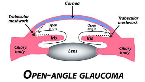 Open-Angle Glaucoma diagram
